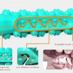 ventosa doble molar 4